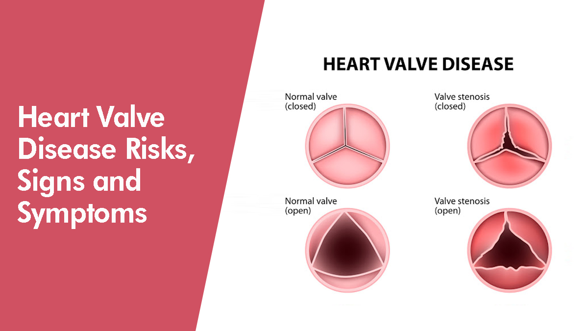HEART VALVE DISEASE RISKS SIGNS AND SYMPTOMS German Heart Centre
