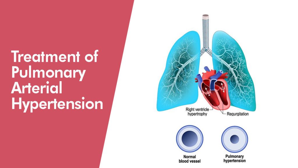 systematic literature review pulmonary arterial hypertension