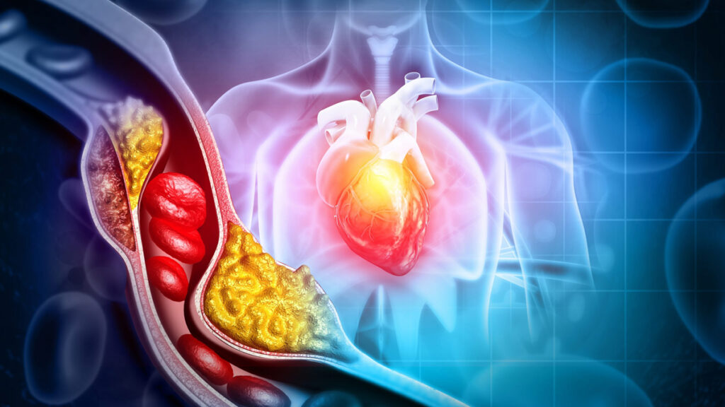 How Cholesterol Is Linked to Heart Disease?