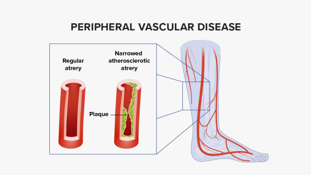 Peripheral Vascular Disease: Signs & Symptoms