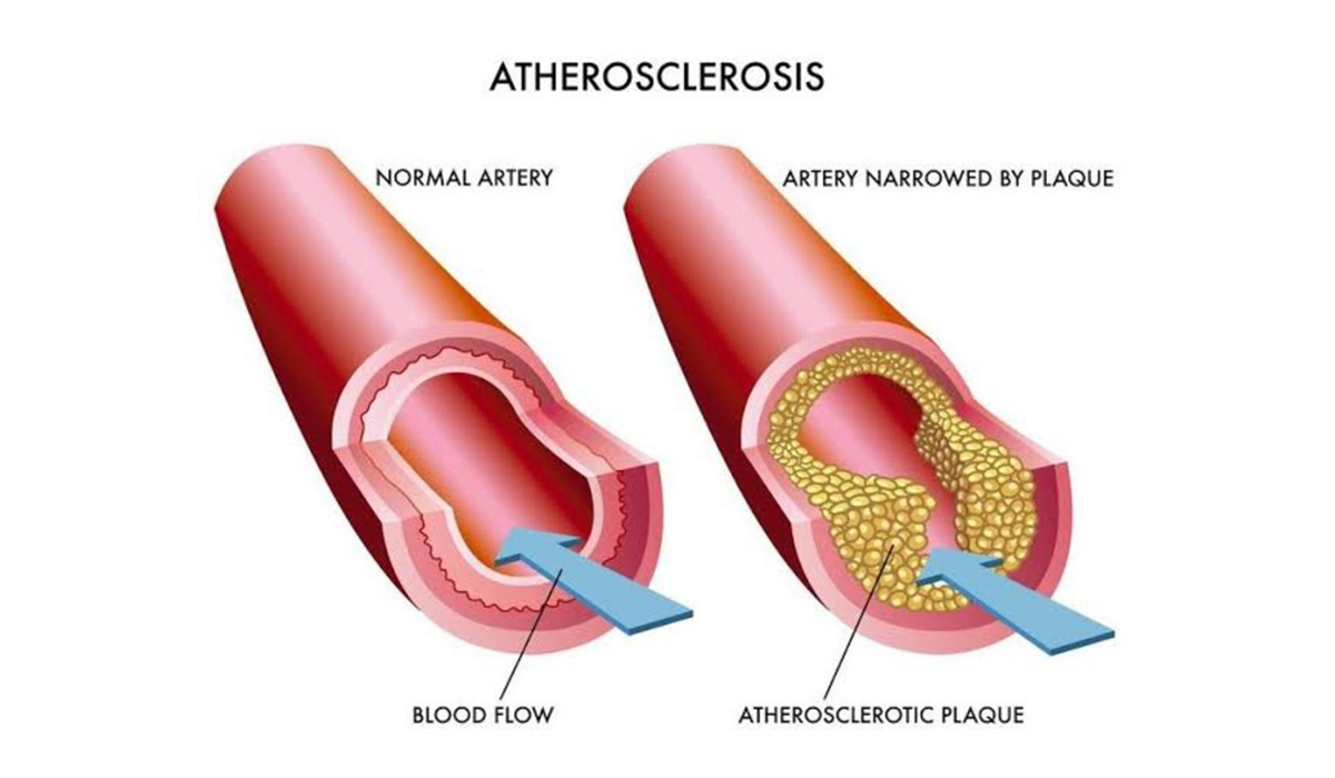 What Is Arteriosclerosis And How Do I Prevent It?
