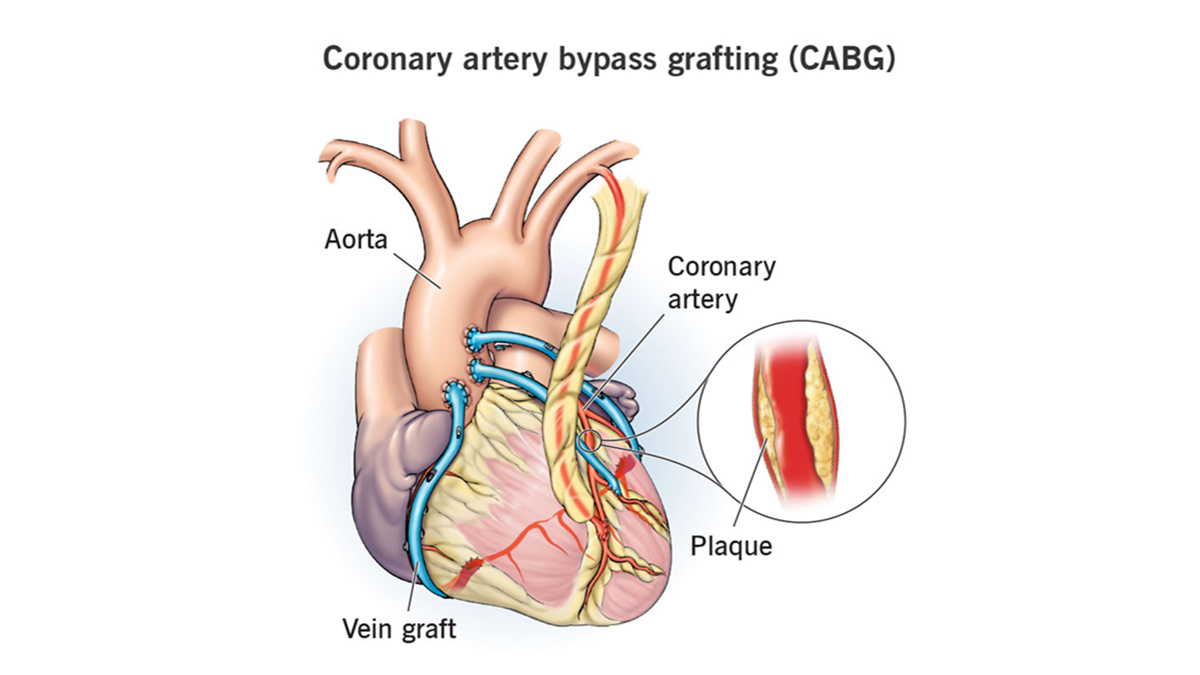 Know About Coronary Artery Bypass Surgery Procedure