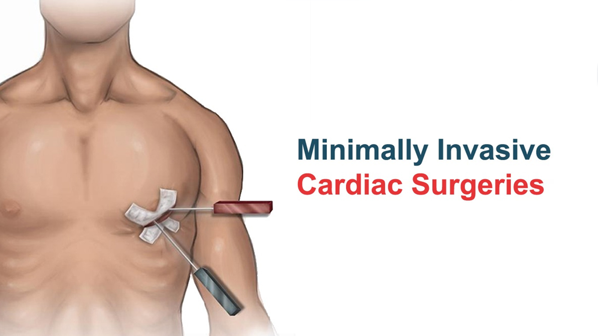 All You Need To Know About Minimally Invasive Cardiac Surgery