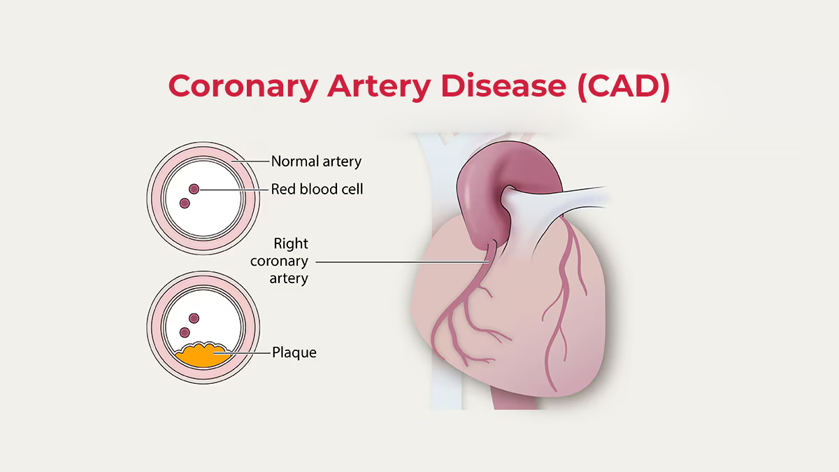 What Is Coronary Heart Disease And How To Prevent It?