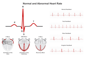 Irregular Heartbeat: Diagnosis and Treatment in Dubai UAE