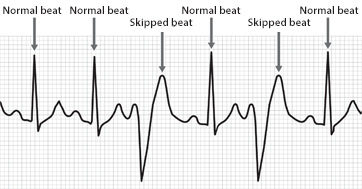 Irregular Heartbeat: Diagnosis and Treatment in Dubai UAE